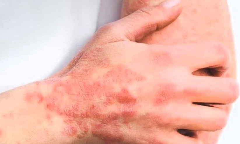 ഇന്ന് ലോക സോറിയാസിസ് ദിനം ;ചികിത്സയിലൂടെ സോറിയാസിസ് നിയന്ത്രണവിധേയമാക്കാം ഇന്ന് ലോക സോറിയാസിസ് ദിനം ;ചികിത്സയിലൂടെ സോറിയാസിസ് നിയന്ത്രണവിധേയമാക്കാം