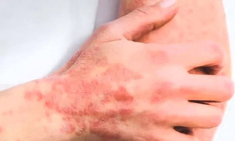 ഇന്ന് ലോക സോറിയാസിസ് ദിനം ;ചികിത്സയിലൂടെ സോറിയാസിസ് നിയന്ത്രണവിധേയമാക്കാം ഇന്ന് ലോക സോറിയാസിസ് ദിനം ;ചികിത്സയിലൂടെ സോറിയാസിസ് നിയന്ത്രണവിധേയമാക്കാം