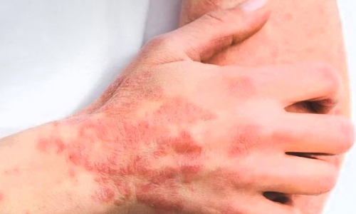 ഇ​ന്ന് ലോ​ക സോ​റി​യാ​സി​സ് ദി​നം ;ചി​കി​ത്സ​യി​ലൂ​ടെ സോ​റി​യാ​സി​സ്  ​നിയ​ന്ത്ര​ണ​വി​ധേ​യ​മാ​ക്കാം