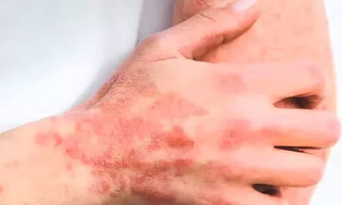 ഇ​ന്ന് ലോ​ക സോ​റി​യാ​സി​സ് ദി​നം ;ചി​കി​ത്സ​യി​ലൂ​ടെ സോ​റി​യാ​സി​സ്  ​നിയ​ന്ത്ര​ണ​വി​ധേ​യ​മാ​ക്കാം