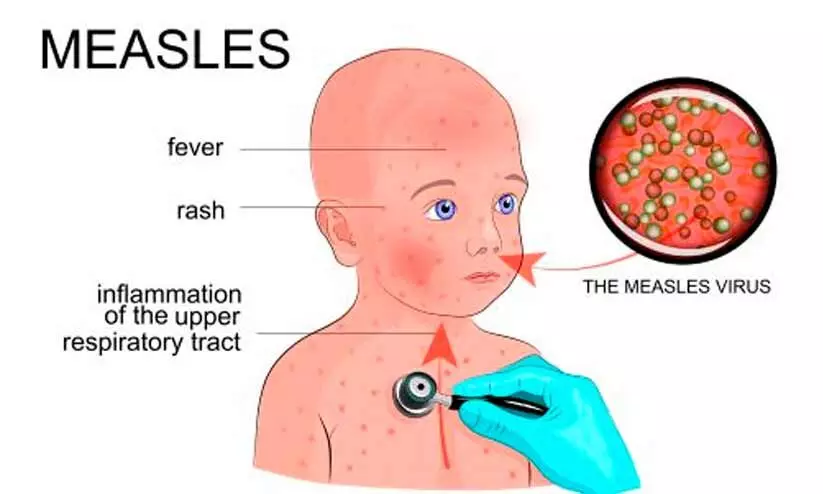 Measles spreads