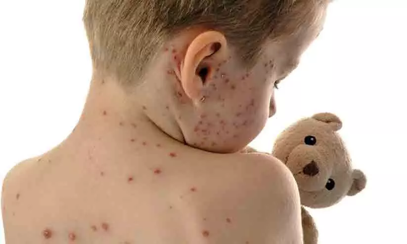 അഞ്ചാംപനി; പ്രതിരോധ പ്രവര്ത്തനങ്ങള് ശക്തിപ്പെടുത്താൻ തീരുമാനം അഞ്ചാംപനി; പ്രതിരോധ പ്രവര്ത്തനങ്ങള് ശക്തിപ്പെടുത്താൻ തീരുമാനം