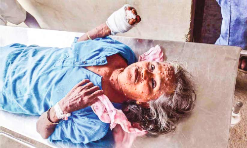 തൊഴിലുറപ്പ് തൊഴിലാളിക്ക് കാട്ടുപന്നി ആക്രമണത്തിൽ പരിക്ക്