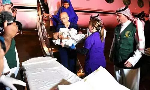 തമ്മിലകലാൻ സാധ്യത തേടി​ നൈജീരിയൻ സയാമീസുകൾ റിയാദിൽ