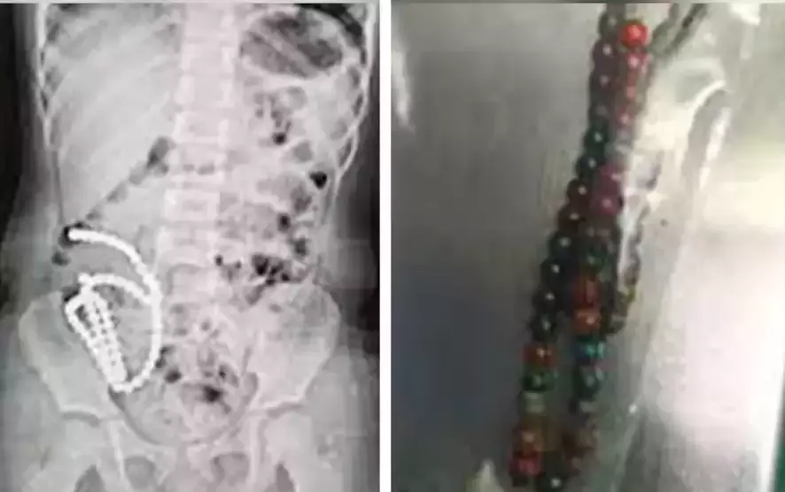 Four Year Old Girl In China Undergoes Surgery After Swallowing 61 Magnetic Beads