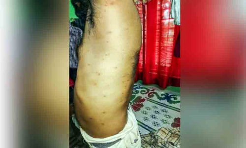 പൊന്നാമലയിൽ പേനിന്‍റെ ആക്രമണം; ആറ് കുടുംബങ്ങൾ നിരീക്ഷണത്തിൽ