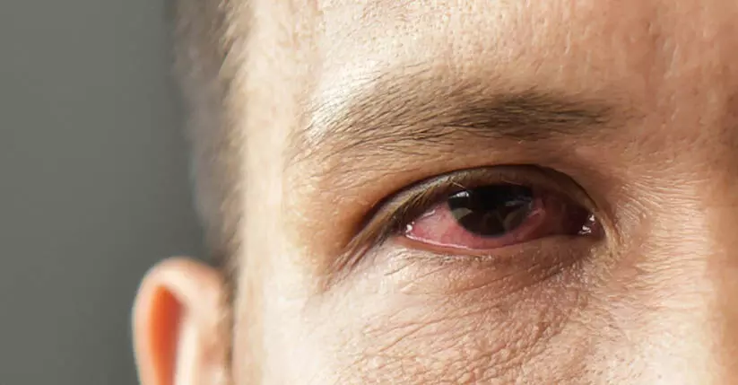 ചെങ്കണ്ണ് സ്വയംചികിത്സ അപകടം ചെങ്കണ്ണ് സ്വയംചികിത്സ അപകടം