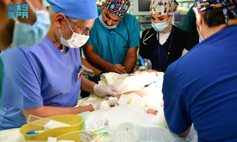 സൗദി സയാമീസ് ഇരട്ടകളെ വേർപ്പെടുത്തി