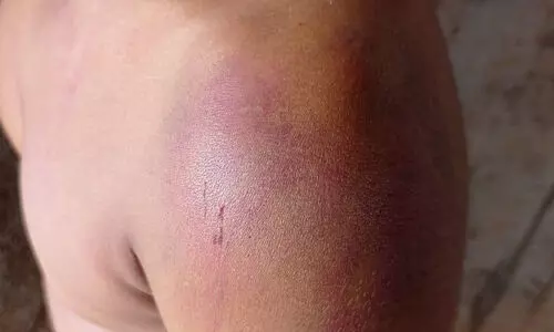 അച്ഛന്റെയും രണ്ടാനമ്മയുടെയും മർദനം; ആറാം ക്ലാസുകാരനെ സംരക്ഷണ കേന്ദ്രത്തിലേക്ക് മാറ്റി