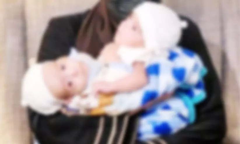 സ​യാ​മീ​സ്​ ഇ​ര​ട്ട​ക​ളെ വേ​ർ​പെ​ടു​ത്ത​ൽ ശ​സ്​​ത്ര​ക്രി​യ ഇ​ന്ന്​