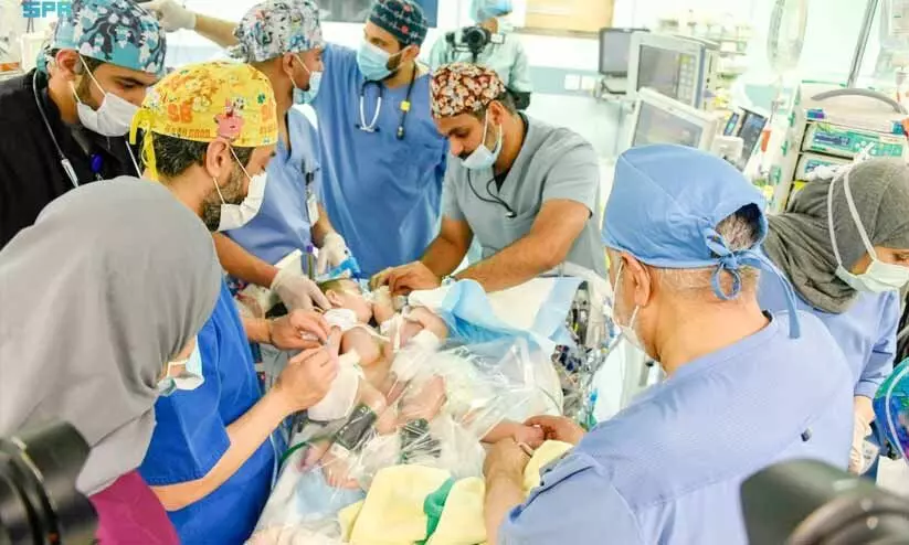 Iraqi Siamese twins undergo surgery