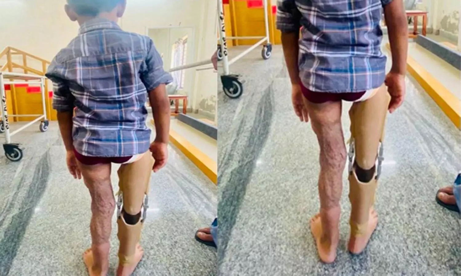 അപകടത്തിലൂടെ വലതുകാല്‍ മുട്ടിന് മീതെ നഷ്ടപ്പെട്ട അഞ്ചു വയസുകാരൻ കൃത്രിമ കാലിലൂടെ മുന്നോട്ട്