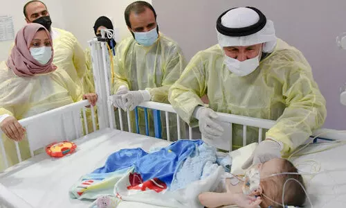 ശസ്​ത്രക്രിയയിലൂടെ വേർപ്പെട്ട ഇറാഖി സയാമീസുകളുടെ ആരോഗ്യ നില തൃപ്​തികരം