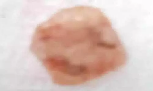 മൂ​ന്ന്​ പ​തി​റ്റാ​ണ്ട്​ ക​ണ്ണി​ൽ ത​റ​ഞ്ഞി​രു​ന്ന ക​ല്ല്​ നീ​ക്കി