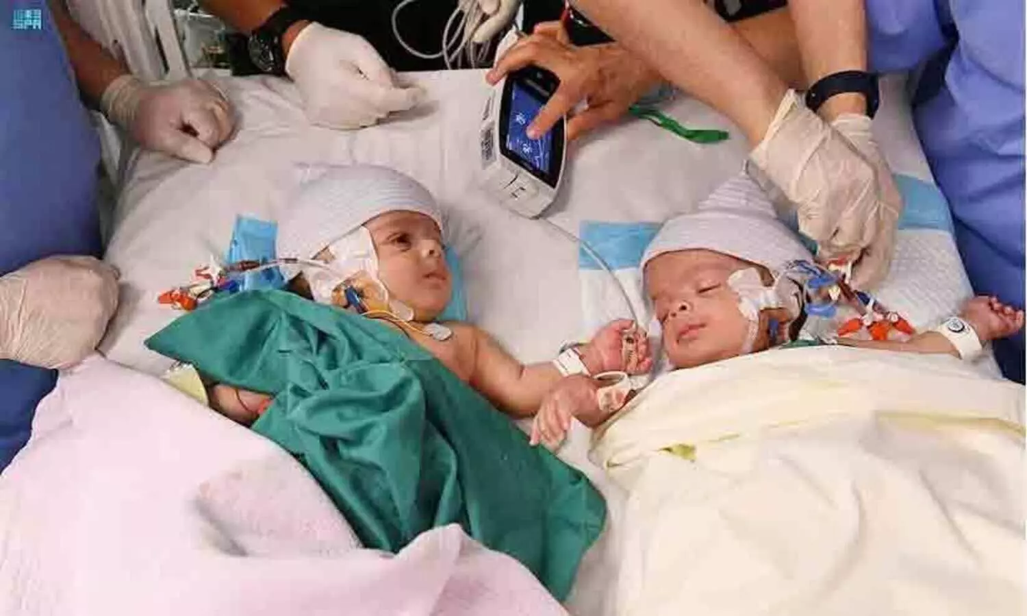 Siamese twins seperated in saudi