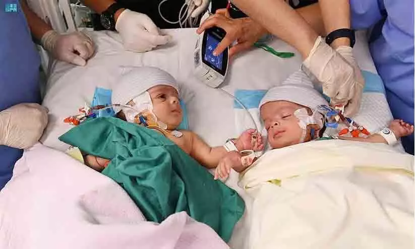 Siamese twins seperated in saudi