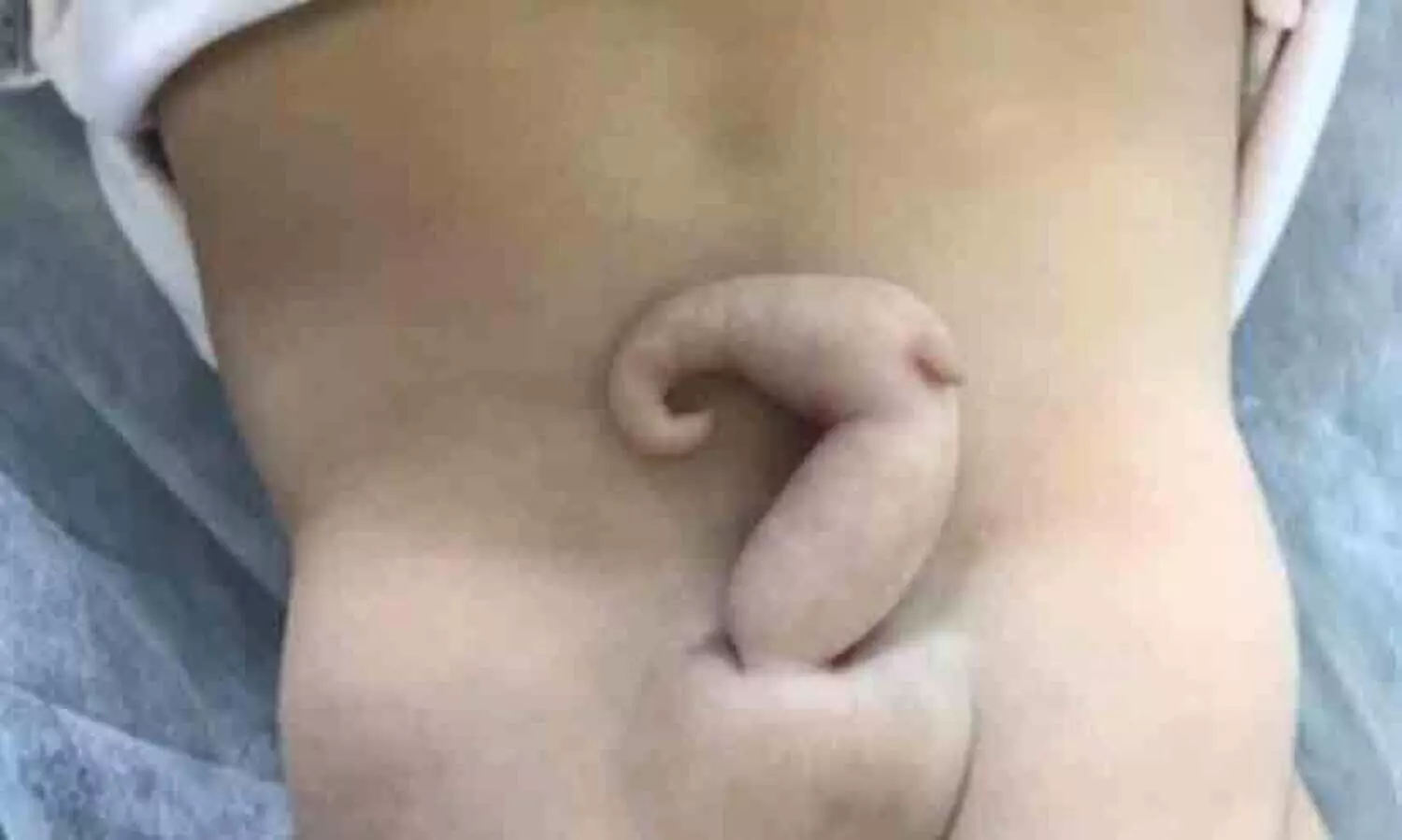 Baby girl with 6 centimetre tail