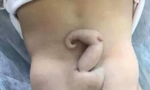 Baby girl with 6 centimetre tail