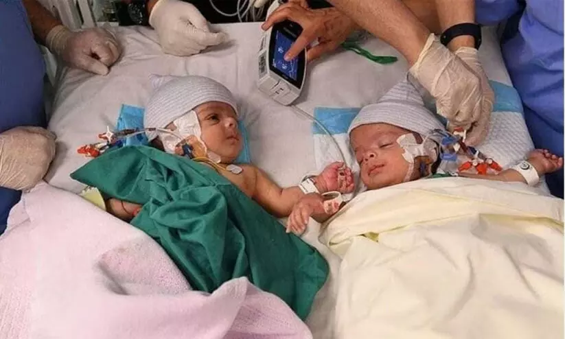 54 സയാമീസ് ഇരട്ടകളെ വേർപെടുത്തി സൗദി; ചികിത്സയും പരിചരണവും സൗജന്യം