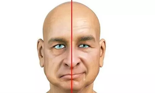 ബെല്‍സ് പാള്‍സി ചികിത്സ ​കൊണ്ട് ഭേദമാക്കാം