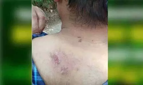 ആനക്കരയിൽ യുവാവിന് സൂര്യതാപമേറ്റു