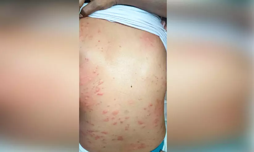 മെ​ഡി​ക്ക​ൽ കോ​ള​ജി​ൽ രോ​ഗി​യു​ടെ പു​റ​ത്ത് മൂ​ട്ട ക​ടി​ച്ച നി​ല​യി​ൽ