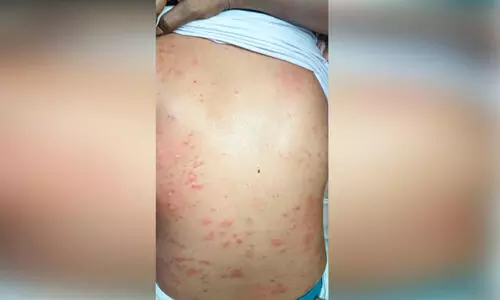 മെ​ഡി​ക്ക​ൽ കോ​ള​ജി​ൽ രോ​ഗി​യു​ടെ പു​റ​ത്ത് മൂ​ട്ട ക​ടി​ച്ച നി​ല​യി​ൽ