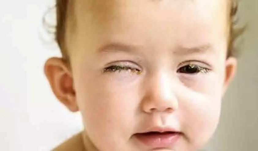 കടുത്ത പനിയും ചുമയും കൺപോളയിൽ വീക്കവും ചൊറിച്ചിലും; പുതിയ കോവിഡ് വകഭേദത്തിന്റെ ഇരകൾ കുട്ടികളെന്ന് മുന്നറിയിപ്പ്