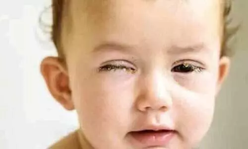 കടുത്ത പനിയും ചുമയും കൺപോളയിൽ വീക്കവും ചൊറിച്ചിലും; പുതിയ കോവിഡ് വകഭേദത്തിന്റെ ഇരകൾ കുട്ടികളെന്ന് മുന്നറിയിപ്പ്