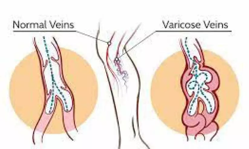 varicose veins