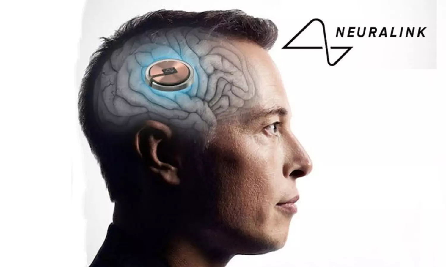 മനുഷ്യ തലച്ചോറിൽ ചിപ്പ് ഘടിപ്പിച്ചുള്ള പരീക്ഷണത്തിന് മസ്കിന് അനുമതി നൽകി എഫ്‌ഡി‌എ