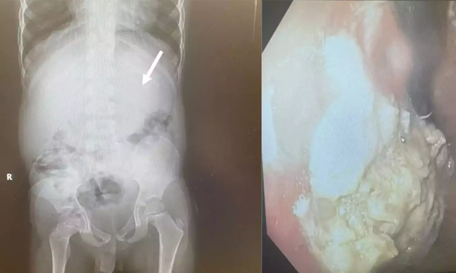 വിഴുങ്ങിയത് 40 ച്യൂയിംഗ് ഗം; അഞ്ചു വയസുകാരന് അടിയന്തര ശസ്ത്രക്രിയ