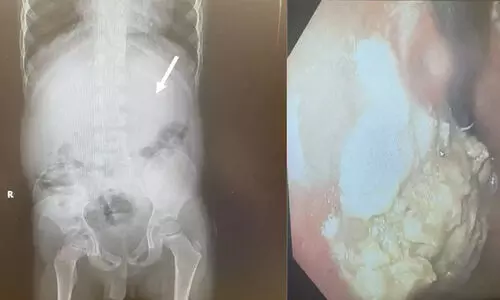 വിഴുങ്ങിയത് 40 ച്യൂയിംഗ് ഗം; അഞ്ചു വയസുകാരന് അടിയന്തര ശസ്ത്രക്രിയ