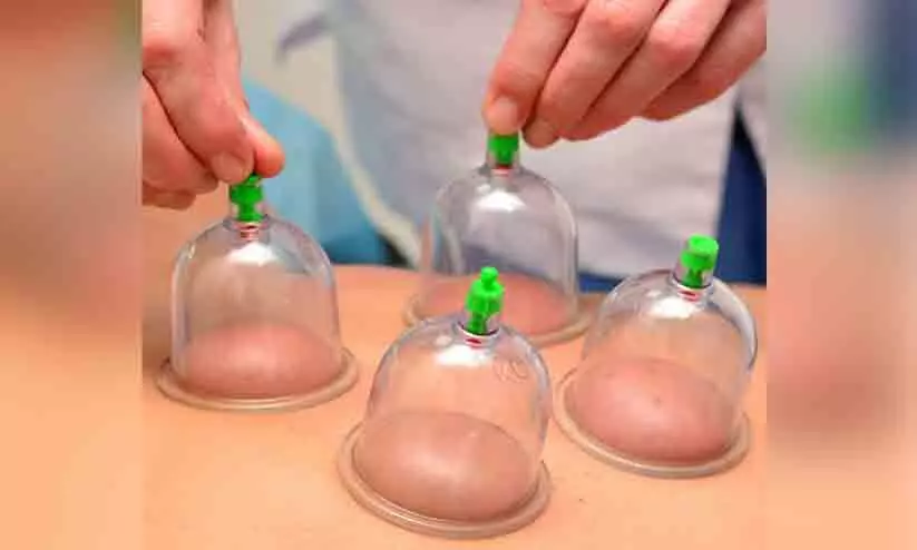 cupping therapy