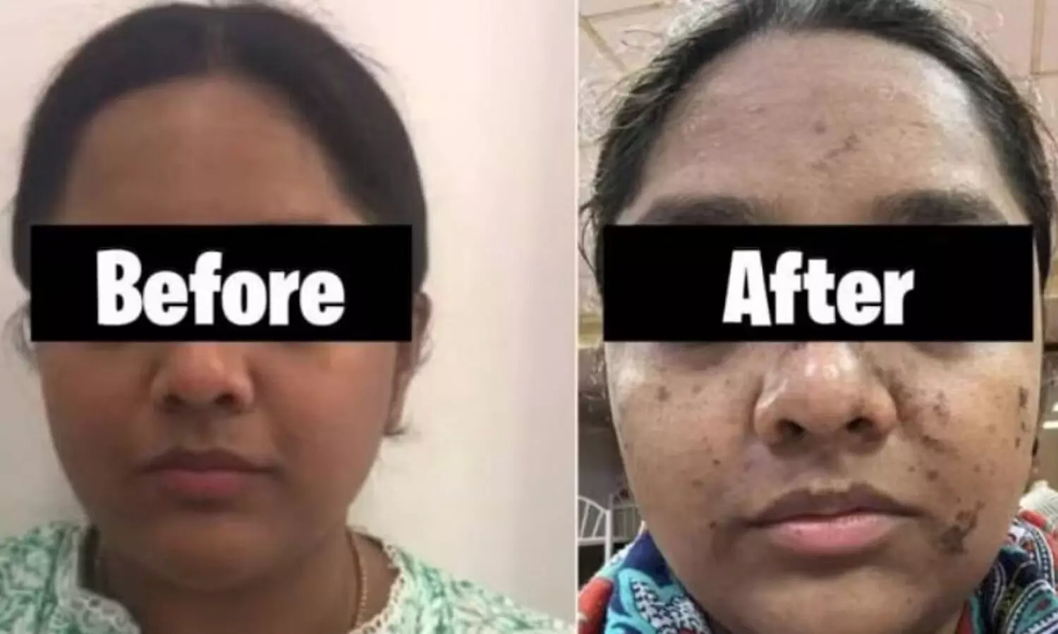 17,500 രൂപയുടെ ഫേഷ്യൽ ചെയ്ത യുവതിയുടെ മുഖം പൊള്ളിയടർന്നു; സലൂണിനെതിരെ കേസ്