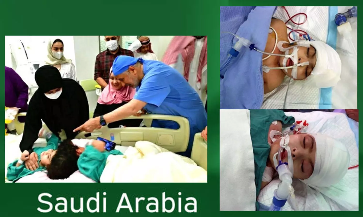 17 മണിക്കൂർ നീണ്ട ശസ്ത്രക്രിയ; തലകൾ തമ്മിൽ ഒട്ടിപ്പിടിച്ച ഈജിപ്ഷ്യൻ കുരുന്നുകളുടെ വേർപെടുത്തൽ വിജയകരം