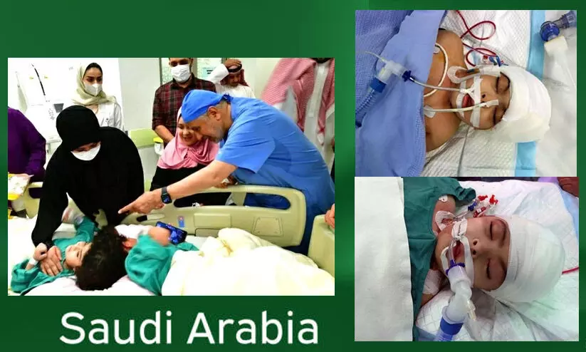 17 മണിക്കൂർ നീണ്ട ശസ്ത്രക്രിയ; തലകൾ തമ്മിൽ ഒട്ടിപ്പിടിച്ച ഈജിപ്ഷ്യൻ കുരുന്നുകളുടെ വേർപെടുത്തൽ വിജയകരം