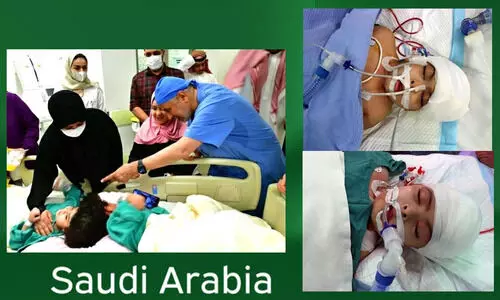 17 മണിക്കൂർ നീണ്ട ശസ്ത്രക്രിയ; തലകൾ തമ്മിൽ ഒട്ടിപ്പിടിച്ച ഈജിപ്ഷ്യൻ കുരുന്നുകളുടെ വേർപെടുത്തൽ വിജയകരം