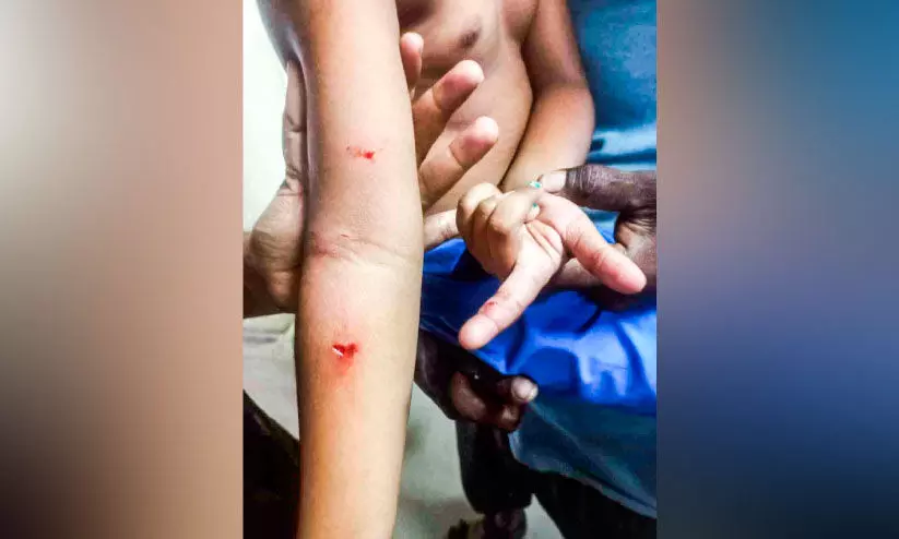 സൈക്കിളിൽ സഞ്ചരിച്ച അഞ്ചുവയസ്സുകാരിക്ക് തെരുവുനായ്​ക്കളുടെ കൂട്ട ആക്രമണം