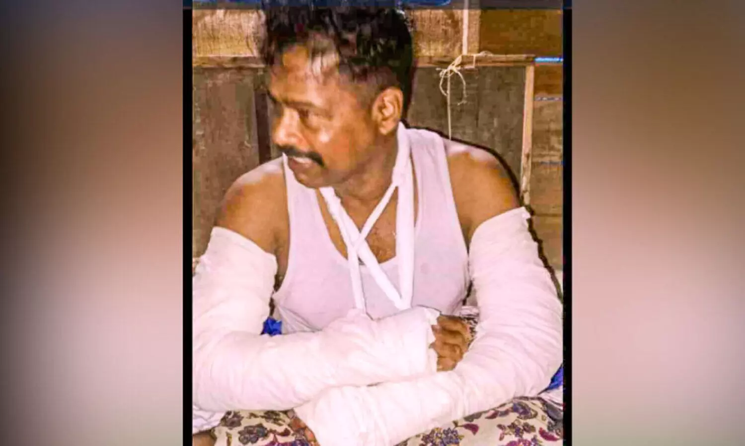 തെരുവുനായ്​ വട്ടംചാടി: റോഡിൽ വീണ ബൈക്ക് യാത്രികന്‍റെ കൈകൾ ഒടിഞ്ഞു