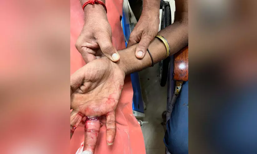 വിരലില്‍ കുടുങ്ങിയ മോതിരം നീക്കം ചെയ്തു