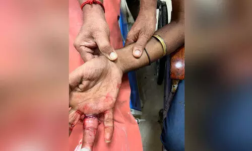 വിരലില്‍ കുടുങ്ങിയ മോതിരം നീക്കം ചെയ്തു