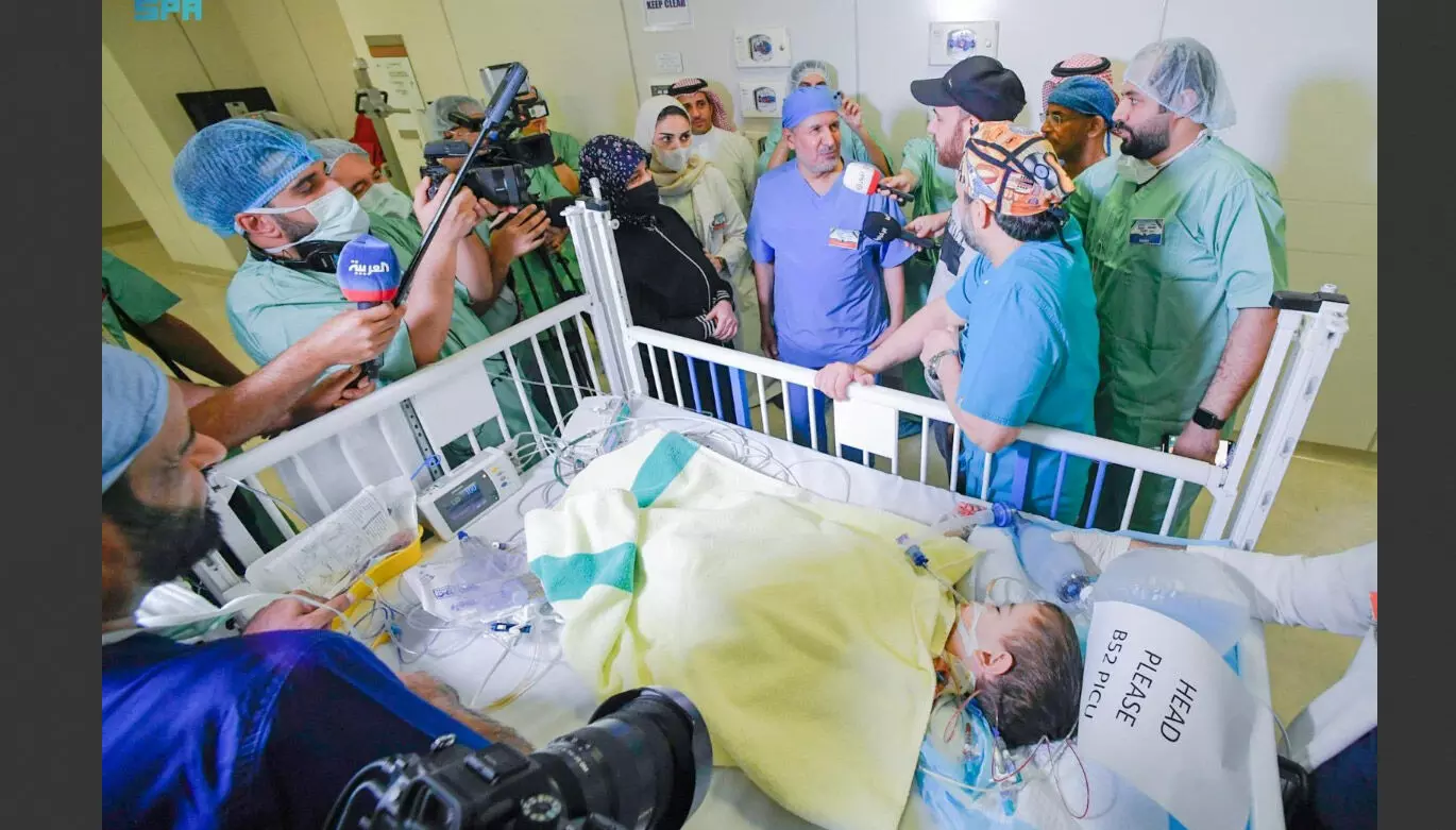 ഇഹ്​സാൻ, ബസ്സാം; സിറിയൻ സയാമീസുകളെ വിജയകരമായി വേർപ്പെടുത്തി