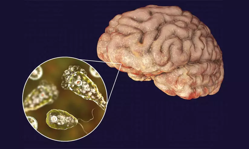 Brain-eating amoeba amebic meningoencephalitis