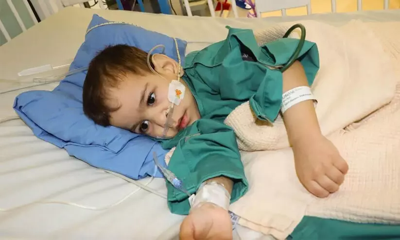 ശസ്​ത്രക്രിയയിലൂടെ വേർപ്പെടുത്തിയ സിറിയൻ സയാമീസ്​ ഇരട്ടകളിലൊരാൾ മരിച്ചു