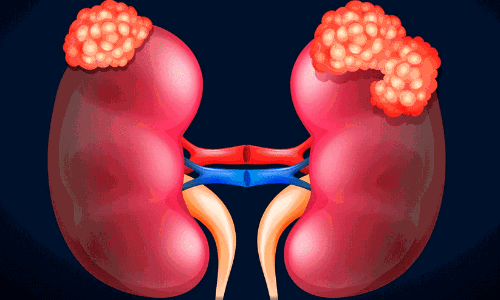 cancer of the kidney