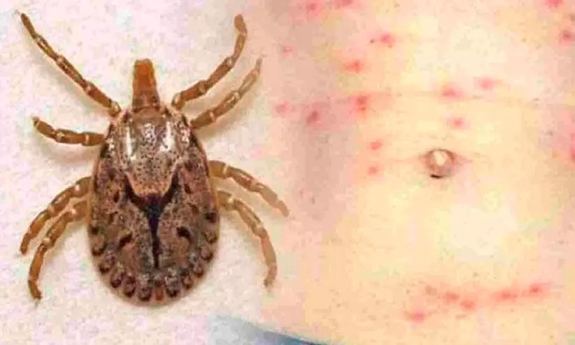 ആലപ്പുഴയില് ചെള്ള് പനി; രോഗലക്ഷണങ്ങള് ശ്രദ്ധിക്കുക ആലപ്പുഴയില് ചെള്ള് പനി; രോഗലക്ഷണങ്ങള് ശ്രദ്ധിക്കുക