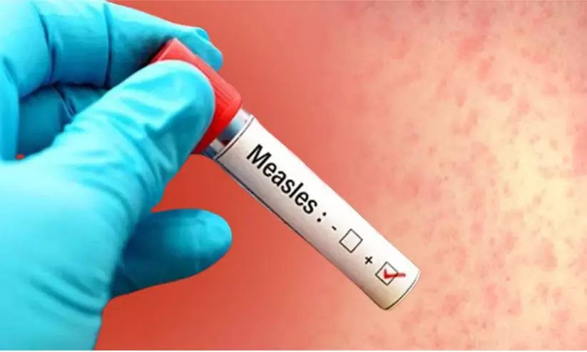 അഞ്ചാംപനി മരണം: കുത്തിവെപ്പ് കർശനമാക്കാൻ ആരോഗ്യവകുപ്പ്