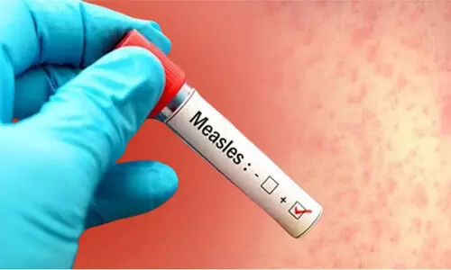 അഞ്ചാംപനി മരണം: കുത്തിവെപ്പ് കർശനമാക്കാൻ ആരോഗ്യവകുപ്പ്