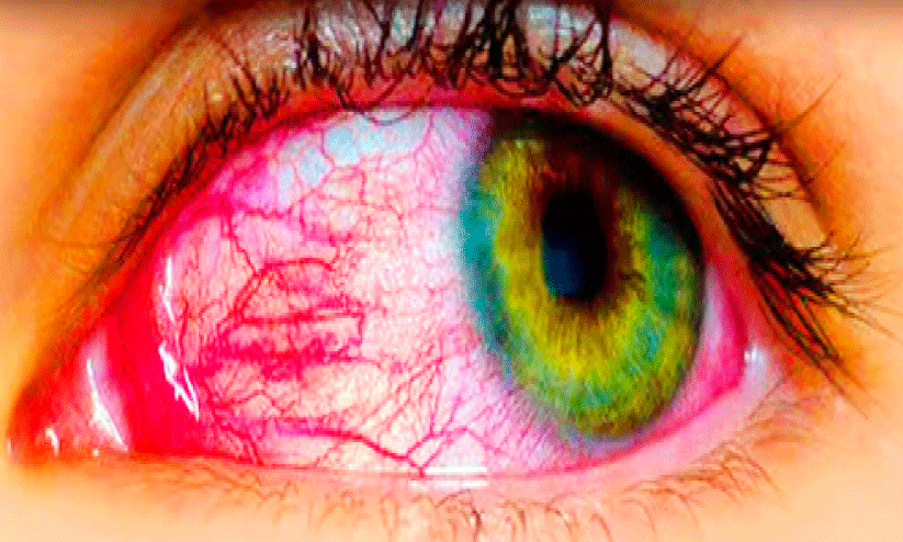 Red eye disease